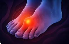 통풍 초기 증상