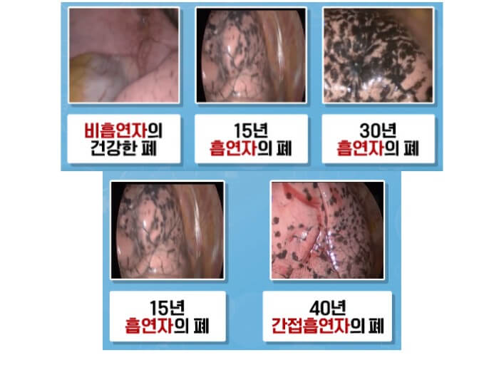 폐의 치명적 손상