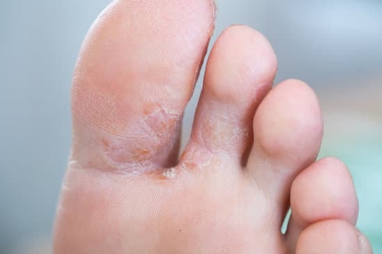 무좀(Tinea, Athlete's Foot): 원인, 증상, 치료 및 예방