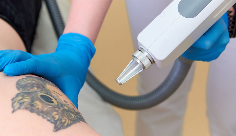 문신제거-레이저-시술