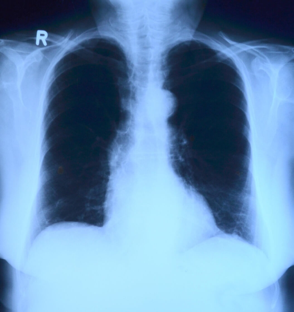 오른쪽 등 통증 의심되는병 8