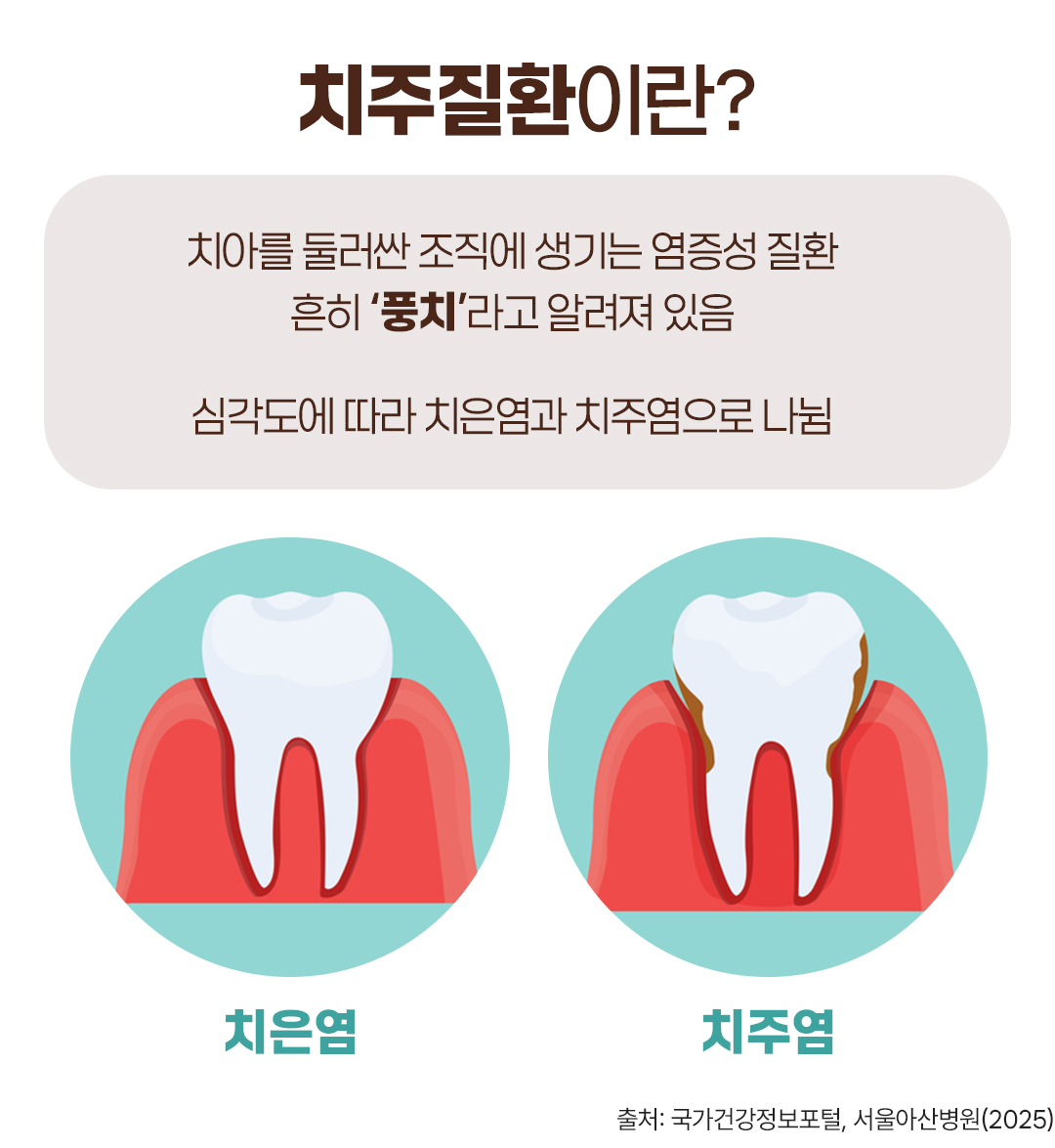 #치주질환이란 #치아를 둘러싼 조직에 생기는 염증성 질환