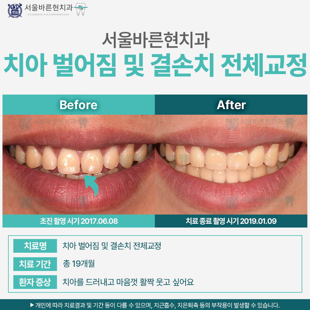 해운대치아교정