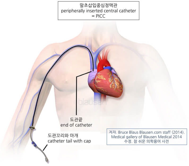 의학용어 IV injection 뜻 정맥주사 부위, 정맥주사 핵심술기