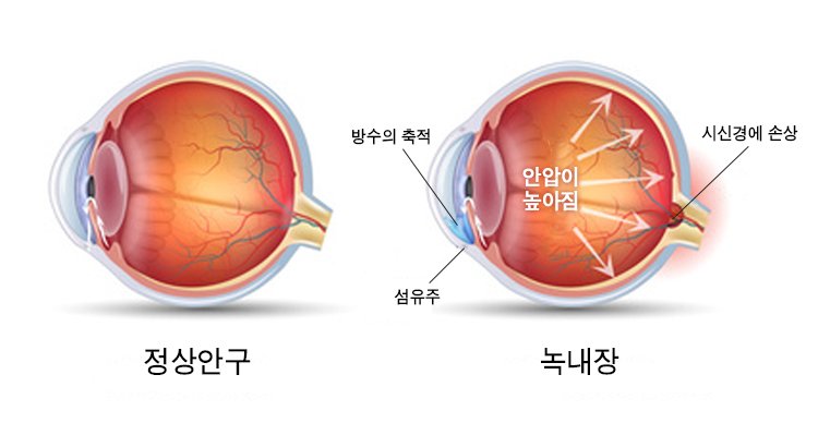녹내장-설명