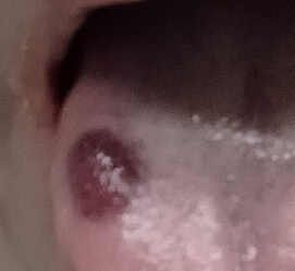 혀-깨물었을때-치료방법