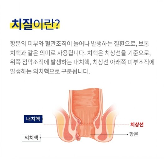 치질 (치핵, 치루) 증상, 원인과 치료