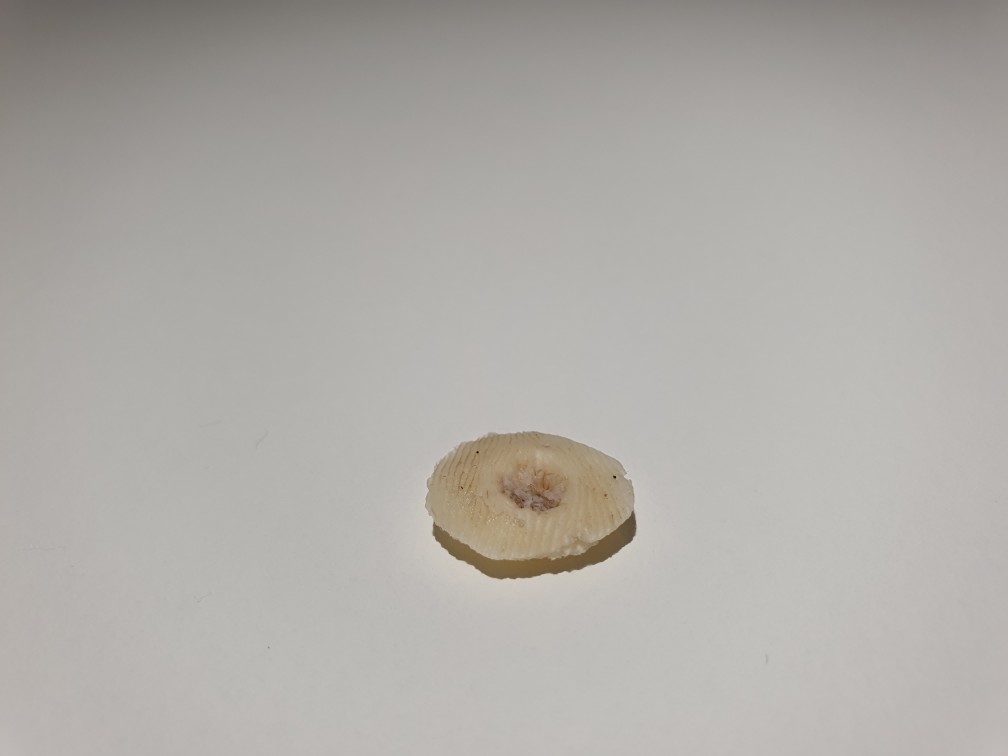 발바닥티눈사진