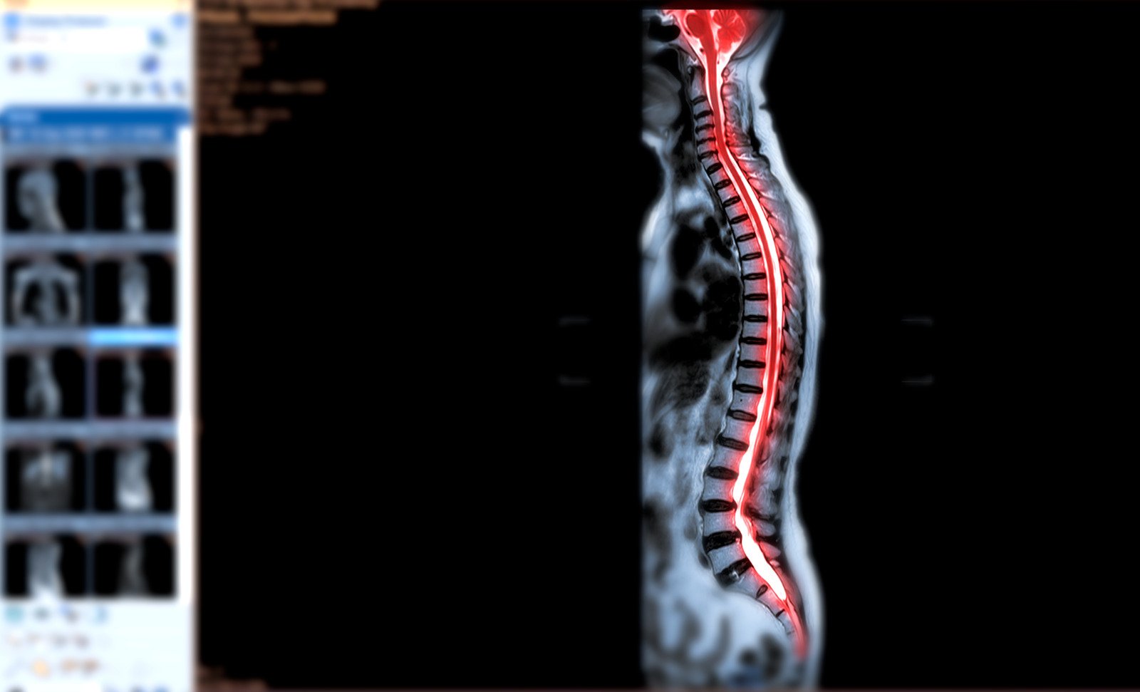척수 신경 압박(Spinal Cord Compression)