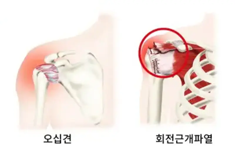 어깨, 팔 통증에 도움되는 스트레칭 방법