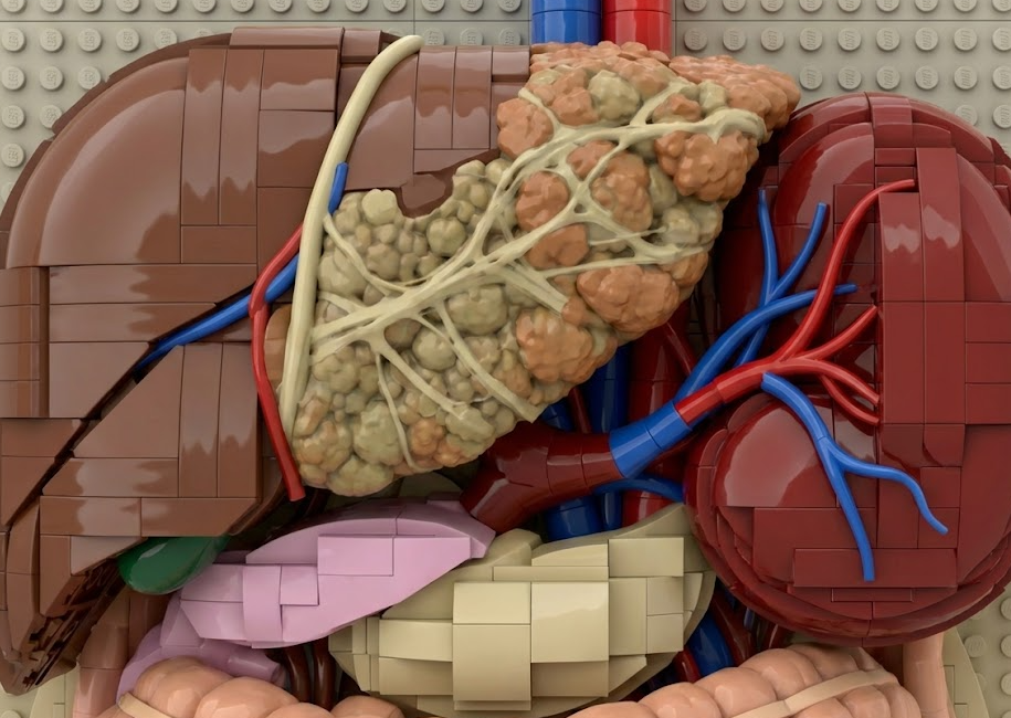 정상 간과 섬유화로 딱딱해진 간을 비교한 레고 블록 형태의 모델 이미지