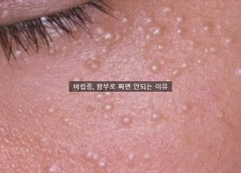 비립종 생기는 이유 비립종 없애는 방법 피부 관리법_6