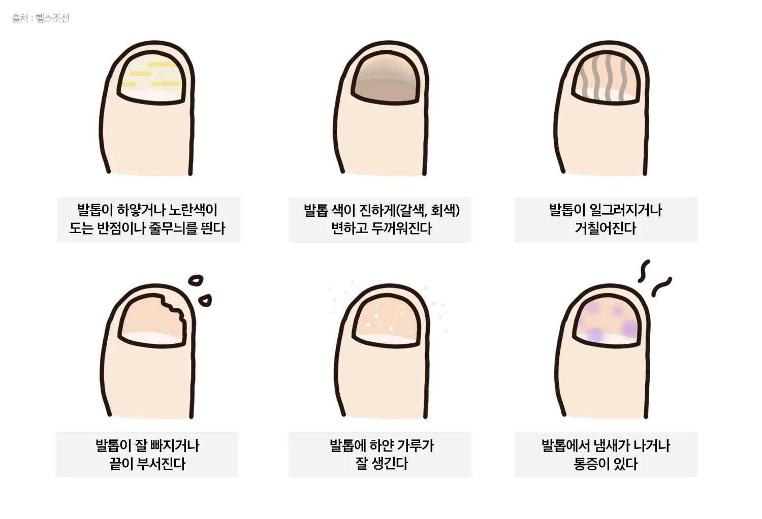 발톱무좀 없애는 방법