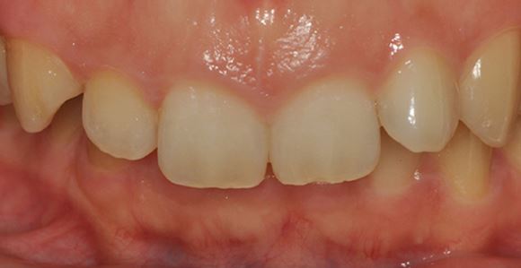 라미네이트-치료