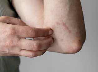 대상포진 초기증상 12