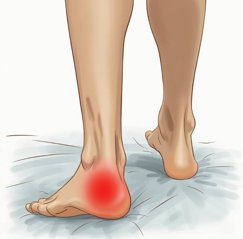 족저근막염 환자가 아침에 일어나 첫 발을 내딛는 모습을 보여주는 일러스트레이션. 통증을 나타내는 빨간색 표시가 발뒤꿈치 부위에 강조되어 있습니다.