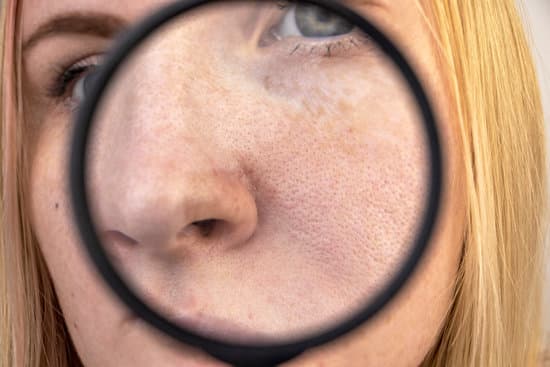 골드 PTT (Gold Photothermal Therapy) ❘ 여드름&middot;모공 치료