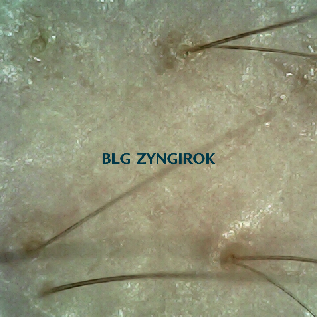 탈모 극복 프로젝트 - 오른쪽 M자 부위 두피 모습이다.