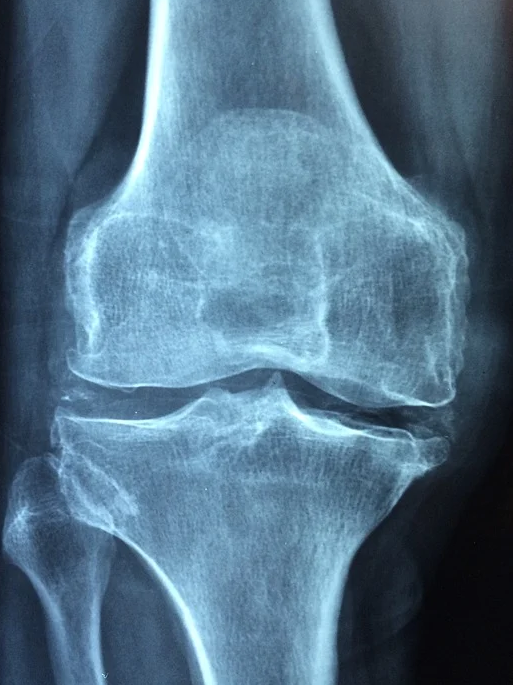 MBP 효능 부작용5