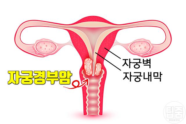 자궁경부암 초기증상