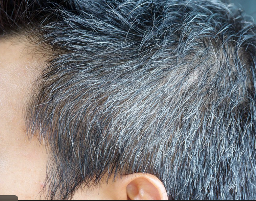 흰머리가 날 때 가려운 이유 5가지|두피가 보내는 신호일 수 있다