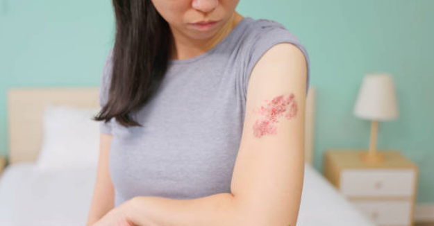 대상포진 증상&amp;#44; 전염&amp;#44; 치료방법 총정리 (2024ver)