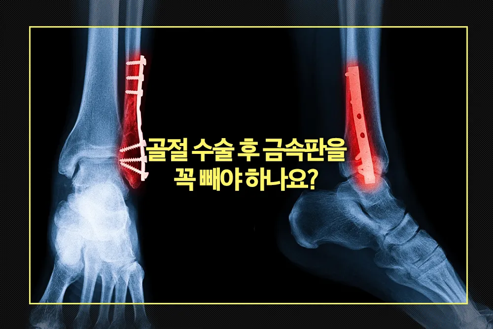 골절 수술 후 금속판을 꼭 빼야 할까