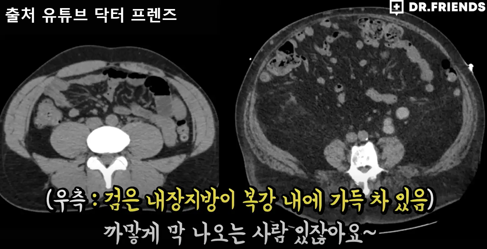내장지방-ct사진