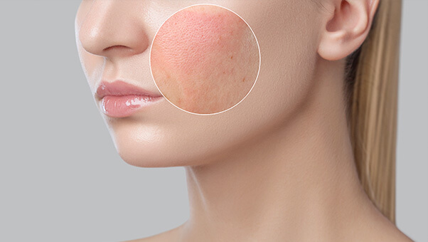 스트레스-증상-피부