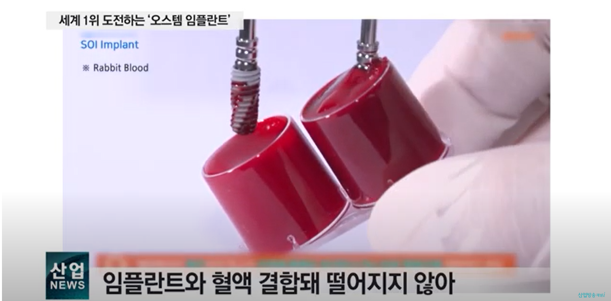 SOI 임플란트는 혈액과 결합하여 떨어지지 않습니다