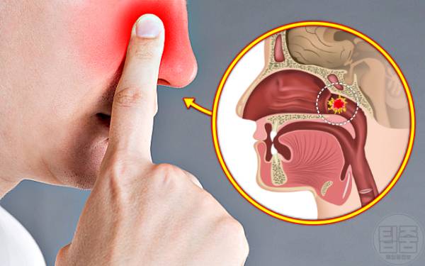 비인두암 증상 비염 증상