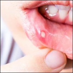 구내염