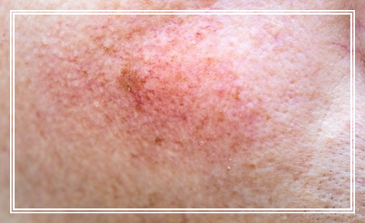 안면이 붉은 모습