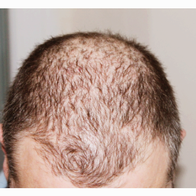 탈모 관련주 대장주 테마주 수혜주 TOP5