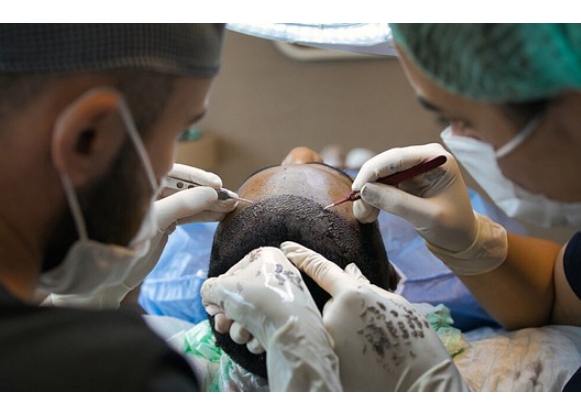 탈모 치료법 중 한가지인 모발이식 수술 장면