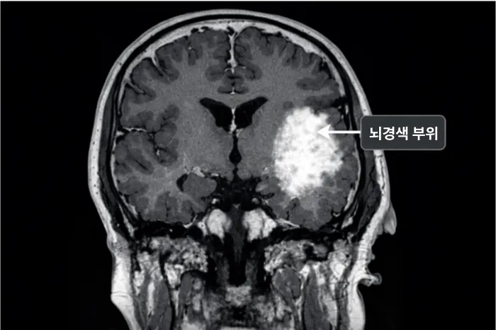 뇌경색 초기증상