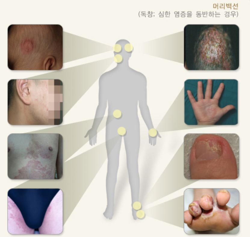 다양한 부위의 피부사상균 병변