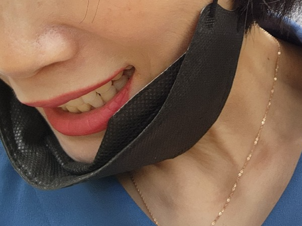 아시클로버 연고 