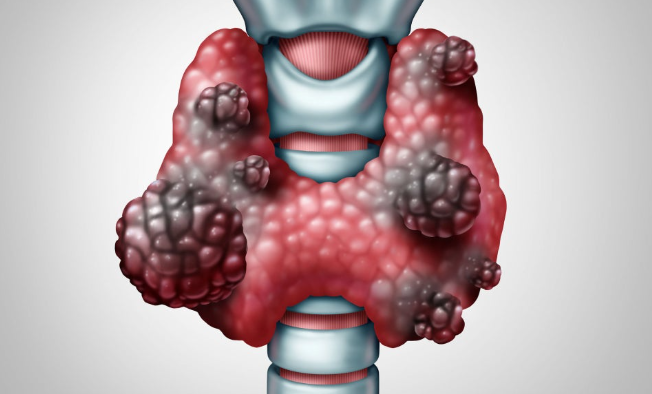 갑상선 결절의 발병 원인