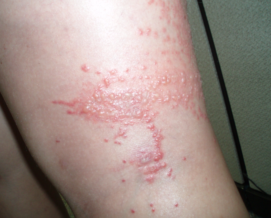 해파리 쏘였을때 관련 이미지5