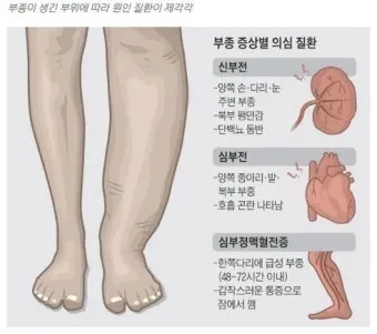 부종의 원인과 증상 5가지 개선방법 치료법_49
