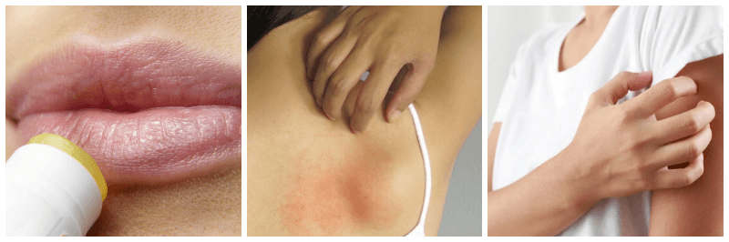 대상포진 관련 사진 3개