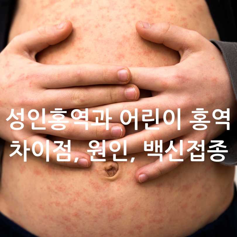 성인 홍역과 어린이 홍역의 차이점