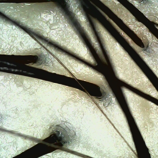 탈모 극복 프로젝트 - 정수리 두피 모습이다.