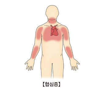 협심증 전조증상