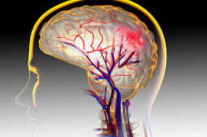 뇌동맥류 초기 증상
