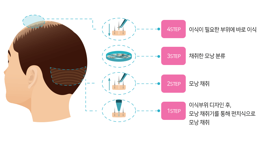모발이식 3000모 비용