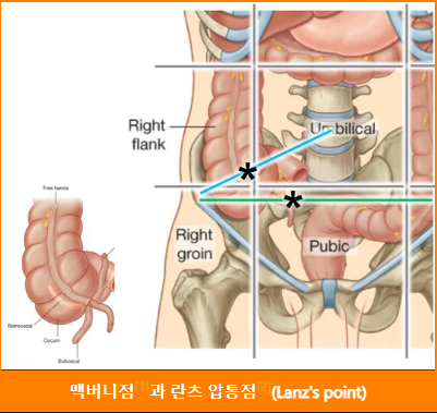 맹장염 압통 부위-맥버니점