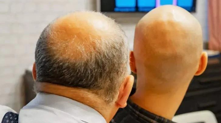 탈모 유전자 검사방법 비용