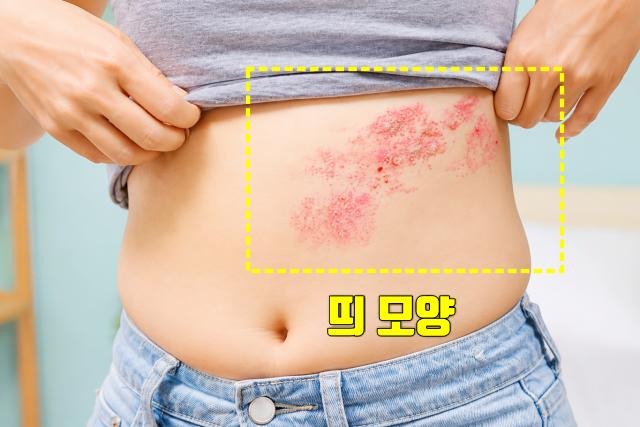 피부 따끔거림 대상포진 증상 붉은 발진 물집